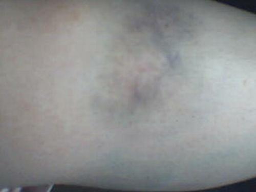 Bruising - This is a huge bruise that I had. Just found it on the computer