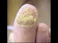 Toenail fungus - I have it the same toe like in the photo but mine is worse! My nail is really thick,has jagged edges and the nail is growing up instead of straight! Hate it!