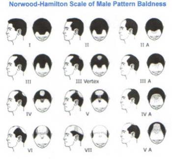 hair fall - hair fall - diagram