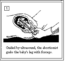 abortion pictorially(click on it to view properly) - its partial abortion