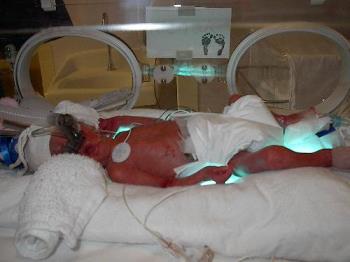 preemie baby - baby born 3 months preemature in incubator.