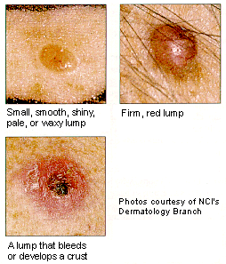 Cancer - Need to know about tm skin cancer? Then feel free to explore the picture and rate is as you will like it :)