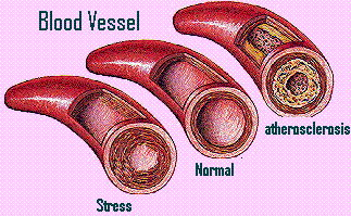 High blood Pressure - High blood pressure directly increases the risk of coronary heart disease (which leads to heart attack) and stroke.