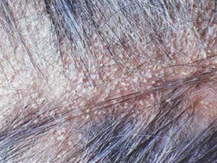 Dandruff photo - this is Dandruff affected head, it is a type of skin decise, it creating hitching and irritating to so many peoples..