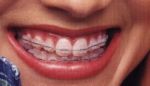 braces - we have to sacrifice for our teeth braces - we have to sacrifice for our teeth