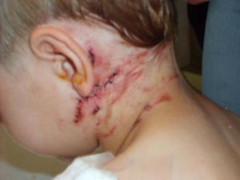 Codys dog attack - Cody attacked by dogs on April 7th 2007! Codys dog attack - Cody attacked by dogs on April 7th 2007!