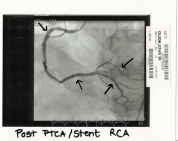 Left After stents/baloon - After photo