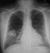 smoker&#039;s lungs - lungs of a smoker