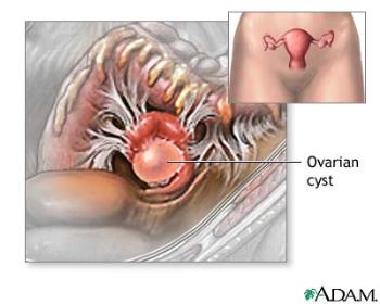 ovarian Cyst - ovarian Cyst can be painful 