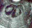 twin utrasound - this is an ultra sound picture of a twin pregnancy!
