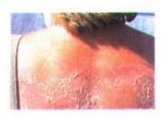 Sunburned skin - Who wants flaky, peeling skin? Sunburned skin - Who wants flaky, peeling skin?