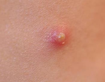 pimples - A pimple is a result of a blockage of the skin's pore. See Acne vulgaris.

Inside the pore are sebaceous glands which produce sticky sebum. When the outer layers of skin shed (as it does continuously), the dead skin cells left behind may become 'glued' together by the sticky sebum. This causes a blockage in the pore, especially when the skin becomes thicker at puberty[1]. The sebaceous glands produce more sebum which builds up behind the blockage, and this sebum harbours various bacteria including the species Propionibacterium acnes. Since the body's natural defence against bacteria is primarily phagocytes (white blood cells), these rush to the site behind the blockage (where the bacteria are). This is what gives some pimples the 'whiteheads' (unless the Phagocytes are deeper in the skin, which means you can't see the 'white' caused by them). The white blood cells then destroy (by phagocytosis) the bacteria to prevent infection. The pain one may feel when a pimple is present is caused by the widening of skin around the white blood cells