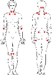 tender points - Fibromyalgia tender points.
What Is Fibromyalgia?
Deborah A. Barrett
Fibromyalgia is a chronic condition characterized primarily by widespread pain throughout the body. The name fibromyalgia, introduced by Muhammad Yunus MD and his colleagues in 1981, literally means pain in the muscles and tissue. "Fibro" refers to the fascia or connective tissue, "my" to muscle, and "algia" to pain. Other ailments associated with fibromyalgia include fatigue, poor quality sleep, difficulty concentrating, sensitivity to light, noise and cold, and irritable bowel.

As many as 2% of the general population may suffer from this condition. No ethnic group seems any more likely to have fibromyalgia; however women develop it approximately 8 times more often than do men.

While the medical community does not yet understand the pathology underlying fibromyalgia, more and more information about this condition is becoming known. Medical researchers are now actively searching for the cause, mechanisms and best treatments for fibromyalgia and related conditions. To keep abreast of scientific studies on fibromyalgia, you can search and read the abstracts of articles on MEDLINEplus, the National Library of Medicine&#039;s database of medical journal articles.

Diagnostic Criteria

In 1990, the diagnosis of fibromyalgia entered the mainstream in the United States. The American College of Rheumatology (ACR) put forward official criteria to recognize this condition:

widespread pain for at least three months in three quadrants of the body, and 
abnormal sensitivity to palpation in at least 11 of 18 specific tender points (as depicted in the illustration). 
These diagnostic criteria provide an important empirical basis to diagnose fibromyalgia. During a physical exam, a physician presses lightly (just until the fingernail whitens) on specific tender points as well as control spots and evaluates the patient&#039;s response. People affected by fibromyalgia may not realize they have tender points until someone familiar with the condition applies pressure to them. Wincing, jumping, or any other visible or vocal response of pain depicts excessive tenderness. It has been the case that people with fibromyalgia see an average of five physicians before receiving the proper diagnosis, but as physicians become more familiar with the tender point exam, diagnoses are made more quickly. The number of tender points that elicit pain can vary and someone with widespread pain but only nine or ten tender points should not be ruled out. The diagnosis of fibromyalgia relies not only on tender points, but on a thorough medical history and appropriate lab tests to rule out alternative diagnoses. 
 



Location of Tender Points. 


Fibromyalgia is not a new syndrome; evidence for its existence dates back centuries. Until recently, however, the cluster of symptoms that comprise fibromyalgia, or fibrositis one of its former names, were largely considered psychogenic. It is the case that doctors who lack a physiological explanation for symptoms are prone to attribute complaints to mental problems or malingering. This has been the case for fibromyalgia because it lacks a clear test to verify its existence, its sufferers "look fine," and are predominantly female, a group less likely believed. This skepticism began to change in the late 1970s and early 1980s when more research became available about sleep abnormalities and reproducible tender spots in fibromyalgia. An important group of rheumatologists (the specialty of physicians that treat arthritis) realized that this group of patients did not fit the profile of hypochondriacs. Rheumatologists started to pay more serious attention to the suffering described by these patients, who continue to make up 20% of a rheumatologist&#039;s practice.

The ACR diagnostic criteria for fibromyalgia came about following an extensive study by 25 medical researchers of more than 500 patients in 16 North American studies. Blinded researchers investigated over 300 different factors in patients with various pain complaints. From this study, they concluded that the most reliable predictors of fibromyalgia are the prevalence of tender points and widespread pain (Wolfe et al., 1989).

In the early 1990s, the World Health Organization declared fibromyalgia a significant medical problem and included it in its 10th International Classification of Disease (ICD-10).

Yet "non-believers" still exist. It may be the case that for some doctors, fibromyalgia will not be considered &#039;real&#039; until its cause and cure are discovered. Fortunately these are becoming fewer and farther between. International conferences of experts now meet regularly to share their findings. Publications on fibromyalgia have increased tremendously, bringing us closer to a fuller understanding of this condition. While rheumatologists were the first to treat fibromyalgia, family physicians are becoming more adept at diagnosing and treating this condition. Doctors of physical medicine, or physiatrists, often specialize in the treatment of fibromyalgia and other pain disorders.

Medical Theories
&#039;Fibromyalgia&#039; is a descriptive name that may change as we learn more about the condition. It could be the case that various different illnesses with similar symptoms are now being included under the rubric of fibromyalgia, or that fibromyalgia is part of a larger family of pain amplification disorders such as migraines or temporomandibular joint (TMJ).

Numerous theories, supported by empirical findings, try to account for what has gone awry in the fibromyalgia body. The simplest explanation is that as with many other conditions such as allergies, heart disease, diabetes, or cancer, a genetic predisposition makes some people more susceptible than others. Fibromyalgia develops when a &#039;triggering incident&#039; throws the body&#039;s system off track. This could be a virus, physical or emotional trauma, repetitive stress, sleep deprivation, or some combination of these. (A small proportion of people seem to be born with fibromyalgia). Exactly what changes in a fibromyalgia body to cause pain and fatigue is not fully understood. The most recent scientific theories consider the pathology to be located in the central nervous system, where pain signals may be amplified or improperly filtered, causing otherwise innocuous stimuli elicit in severe pain. Researchers have found that people with fibromyalgia have elevated amounts of the neurotransmitters that signal pain responses (Substance P), as well as depressed levels of natural pain killers (serotonin) and hormones that restore muscle regeneration (growth hormone). Other findings include abnormal sleep patterns, mainly a decrease in slow-wave deep-levels of sleep that are most restful to the muscles. These all represent important pieces of the puzzle.

Treatments for Fibromyalgia
The good news about fibromyalgia is that there does not seem to be any underlying pathology that worsens. Treatments therefore focus on alleviating symptoms of pain and sleeplessness. The difficulties of fibromyalgia tend to cycle. When pain is severe, it interferes with sleep, which worsens pain, mood, cognitive ability, and so on. Treatments aim to break this cycle and reverse its direction. In other words, when reducing pain, allows sleep to become easier, which further reduces pain and fatigue, and so on.

The treatments for fibromyalgia sound easy in that they all read like basic practices for good health and well being. They include: (1) a carefully planned exercise program that includes gentle stretching and gradual progression toward aerobic conditioning; and (2) drug therapy, primarily to improve sleep. Physical therapy may be helpful and could include such techniques as heat, ice, massage, whirlpool, and electrical stimulation to help control pain. Some patients benefit from medication for pain relief. However, whatever is wrong with the fibromyalgia body makes things like exercise and sleep a challenge. Nonetheless, with much patience and a good understanding of one&#039;s body&#039;s reactions, people with this condition can improve how they feel.

Exercise may sound to others like an easy antidote. However, when you are in pain, exercise is not easy. Furthermore, people with fibromyalgia do not respond to exercise like other people and need to approach it gradually. But if approached appropriately and gradually, exercise can provide natural painkillers, improve strength, endurance, and fitness. A regular exercise program can decrease pain and improve overall well being, sleep quality, and daily stamina. See my article on exercise.

Good quality sleep is a bedrock of fibromyalgia treatment. Studies have shown that sleep deprivation can induce fibromyalgia-like symptoms. Many people with fibromyalgia suffer from sleep abnormalities and often awake feeling as if they had not slept at all. This is called nonrestorative sleep. There are many different medicines that can improve sleep quality. It may take several tries to find the ones that work best for each individual. The recommended approach is to begin with small doses of medicine to see how they are tolerated, then increase as needed. The goal is to improve sleep without introducing unpleasant side effects. Talk with your doctor about how each medicine works and the expected duration of any side effects. Bedtime routines are also very important for improving sleep. Wind down your day with something soothing such as a hot bath. Try to organize your days to allow yourself the best possible rest. Limit daytime naps. Exercise improves sleep quality, but it is best not to exercise directly before sleep. Make sure your mattress and pillow(s) provide appropriate support and cushion. Earplugs can be very helpful to block disturbing noise. Adjust your sleep environment such as the temperature, humidity, and darkness to your preference. Create a relaxing bedtime ritual and aim for a solid eight hours. Click her