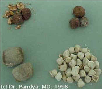 Gallstone_Gall Blader - What are GALLSTONES?

Some people form different size stones in the gallbladder. There may be a single stone or as many as 100 or more. Some stones are made of cholesterol, calcium, a blood pigment, or complex mixed stones with combination of above.

What is gallbladder and what is its function in the body?

Gallbladder is a pear shaped and sized bile bag, that is part of the biliary tree. It is connected to the bile tube coming from the liver. This bile tube is called common bile duct that joins with a tube coming from an organ called pancreas and opens in to a part of intestine called duodenum. The normal function of the gallbladder is to store the bile produced by the liver until a person eats and then the gallbladder muscles squeeze the bile in to the common bile duct to empty in to the duodenum, where it plays a part in the digestion of fatty food.

Are gallstones normally present in everyone?

No gallstones are normally present in everyone. The presence of gallstones in gallbladder indicates the diseased gallbladder. The person is at an increased risk of complications of gallstones. These include gallstone attacks, infection of gallbladder, passage of stones in the common bile duct, obstruction of common bile duct, cholangitis, yellow jaundice, gallstone Pancreatitis to name a few.

What happens when some one has gallstones?

Gall stones in the gallbladder act as a ball valve. Whenever gallbladder contracts the stones get wedged in to the outlet tube called cystic duct. This leads to increase of pressure inside the gall bladder. This produces referred pain and discomfort. Some people describe that as gas pain in upper abdomen, or right side back or right upper side of the abdomen under the rib cage. This can also produce vomiting. The symptoms can mimic heart attack or angina. Fatty foods are usually the culprit in the attacks but virtually any food can cause gall stone attacks. The pain or discomfort may ease up when the stone falls back or passes down the cystic duct in to the common bile duct.