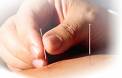 Acupuncture - Acupuncture