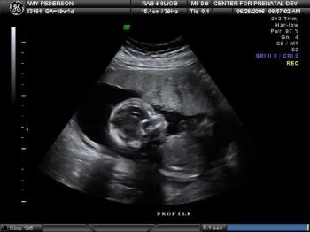 snoogins - Ultrasound photos