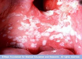 So Grateful I Can&#039;t See Mine! - This is what oral thrush looks like - ugh