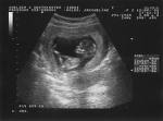 Baby - The scan image showing a 21 days child growth.