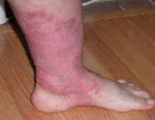 foot psoriasis - foot psoriasis is a particularly challenging form of disease. Difficult to endure and to treat. 