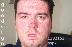 CHICKENpox - Chicken pox is spread easily to others by direct person-to-person contact, by droplet or airborne spread of discharges from an infected person&#039;s nose and throat or indirectly by contact with articles freshly soiled by discharges from the infected person&#039;s lesions. The scabs themselves are not considered infectious. 

*[http://www.mylot.com/w/discussion/1332153]*