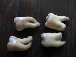 wisdom teeth - a photo of four wisdom teeth