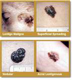 melanoma - is skin cancer in which can kill