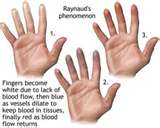 raynaud's phenomenon - I looked it up and now I know what it is raynaud's phenomenon - I looked it up and now I know what it is