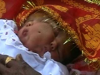 Baby w/two faces - Girl born in India with Two faces