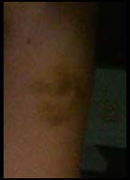 my bruised arm - here&#039;s what I got from a drunk driver!