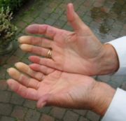 Hands with Raynauds disease - photo of hands with Raynauds disease