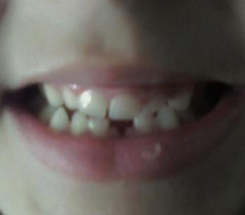 first tooth gone - Maverick looses first tooth