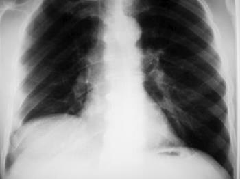 chest infection - xray show chest infection