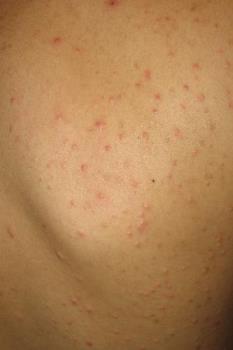 skin rash - picture of my son's skin rash