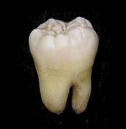 molar tooth - cavities at molar tooth really caused tooth sensitivity.