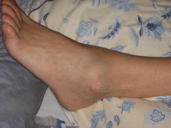 Sprained Ankle - Sprained/Broken Ankle