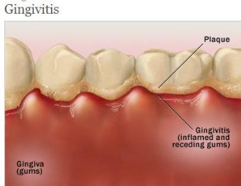 Teeth with gingivitis - Teeth with gum disease - gingivitis