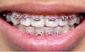 braces for teeth - would you like to put braces on your teeth?