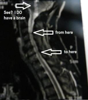My poor neck - Here&#039;s the impingement in my neck, plus a little brain. Not that I have a little brain, but, err, well, all it showed was a little brain. Maybe I DO have a little brain but at least I have one! 