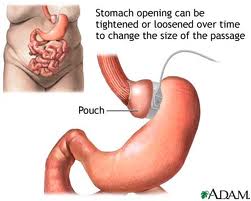 Not all diet can work in all t ype of people. - FAster solution like lap band required to safe very obese peeople