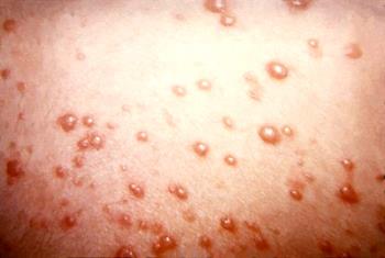 chicken pox - chicken pox is a contagious disease caused by varicella zoster virus. A person can only have this at once and he/she will be immune to it