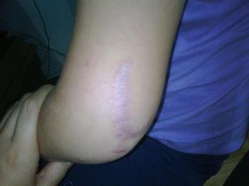 My daughter's scar - My daughter fell through a bottom-floor window and she was rushed to Emergency. This is why I carry a well-stocked first aid kit everywhere I go.
My daughter's scar - My daughter fell through a bottom-floor window and she was rushed to Emergency. This is why I carry a well-stocked first aid kit everywhere I go.