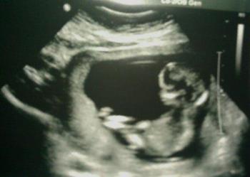 Innocent life  - Ultrasound result