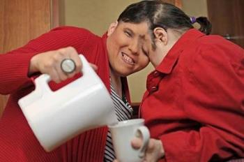 Conjoined Twins are 50 years old - Conjoined Twins celebrate the big 50