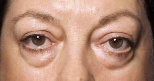 heavy eye bags hanging - This is what you would look like when you do not sleep enough!