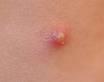 Pimple - I find that putting toothpaste on a pimple gets rid of it faster. 
