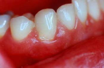 bleeding gum - Gingivitis is the most common cause of bleeding gum.