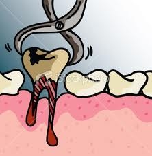 Tooth extraction - Tooth extraction is painful
