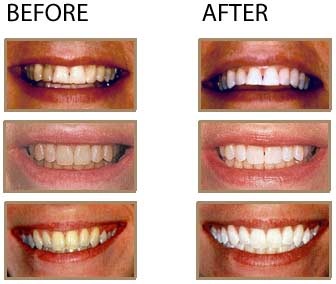Whitening toothpaste - White teeth in 2 weeks