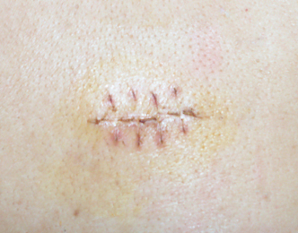 My stitches - This is how my back looked like after a week