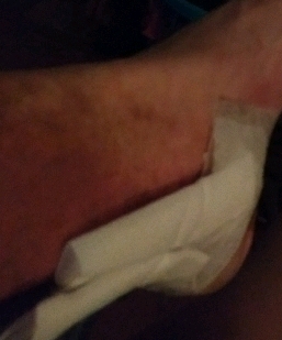 Bandaging over the wounds near my ankle.